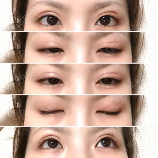 6日目の経過画像（1枚目）