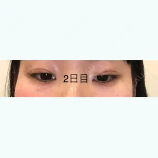 1日目の経過画像（3枚目）