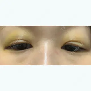 6日目の経過画像（2枚目）