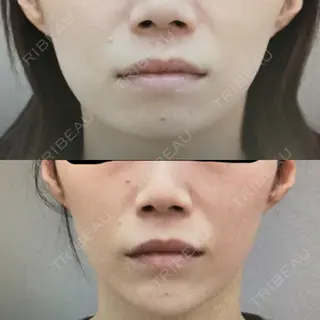 38日目の経過画像（1枚目）