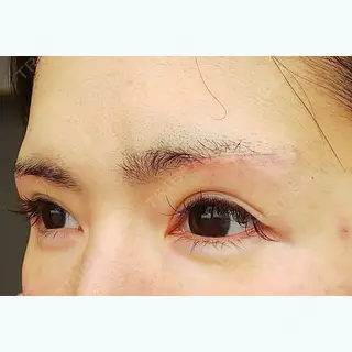 15日目の経過画像（3枚目）