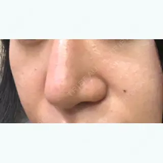 5日目の経過画像（3枚目）