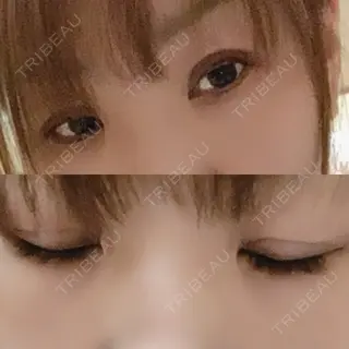 3日目の経過画像（2枚目）