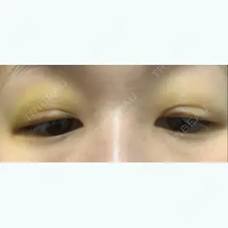7日目の経過画像（2枚目）