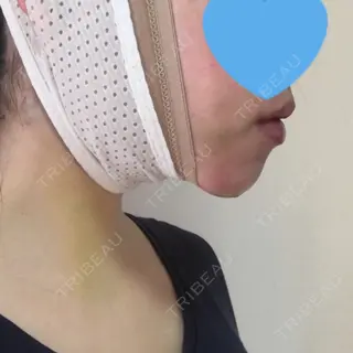 4日目の経過画像（3枚目）