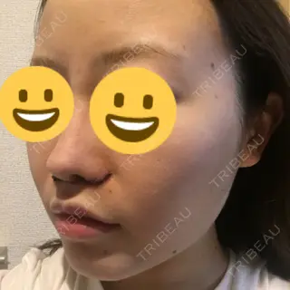 7日目の経過画像（2枚目）