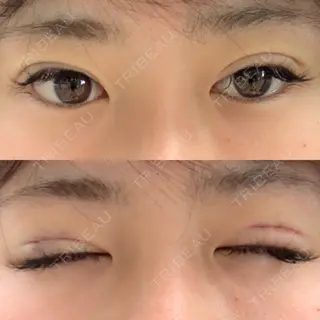 0日目の経過画像（1枚目）