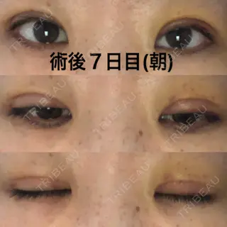 7日目の経過画像（1枚目）