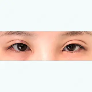 15日目の経過画像（2枚目）