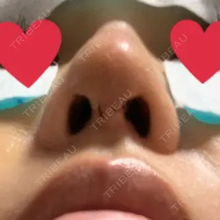 5日目の経過画像（2枚目）