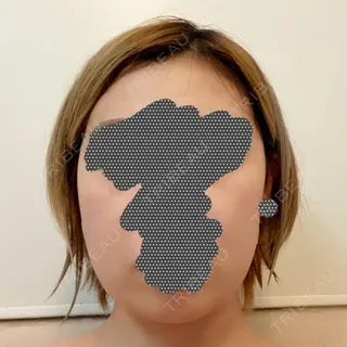 1日目の経過画像（1枚目）