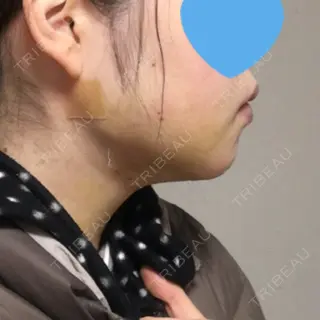 6日目の経過画像（3枚目）