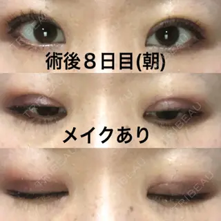 8日目の経過画像（1枚目）