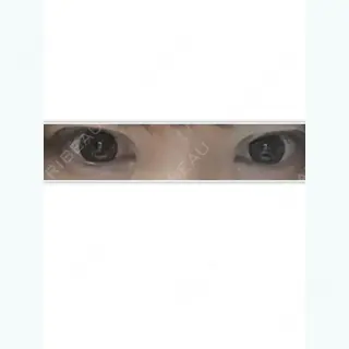 12日目の経過画像（2枚目）