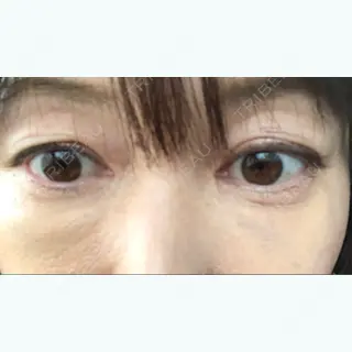 7日目の経過画像（3枚目）