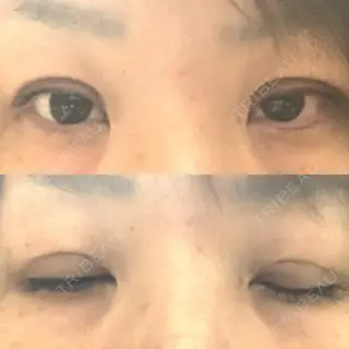 6日目の経過画像（1枚目）