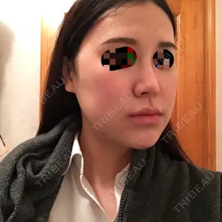 9日目の経過画像（3枚目）