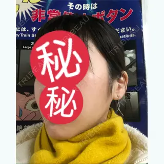 21日目の経過画像（2枚目）