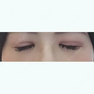 16日目の経過画像（2枚目）