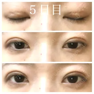 5日目の経過画像（1枚目）
