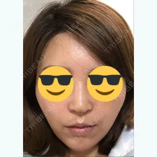 12日目の経過画像（3枚目）
