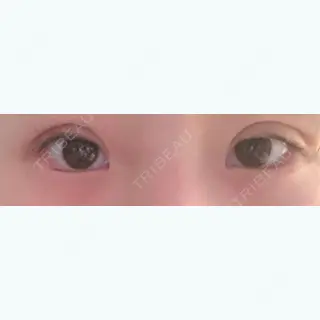 0日目の経過画像（1枚目）