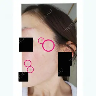 17日目の経過画像（1枚目）