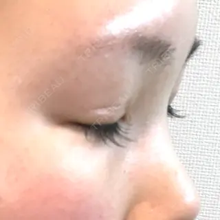 31日目の経過画像（2枚目）