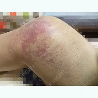 12日目の経過画像（1枚目）