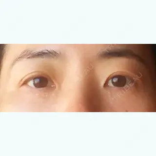 23日目の経過画像（1枚目）