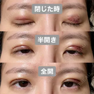 2日目の経過画像（1枚目）
