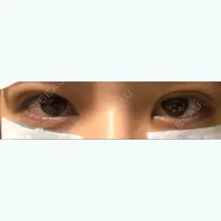 0日目の経過画像（1枚目）