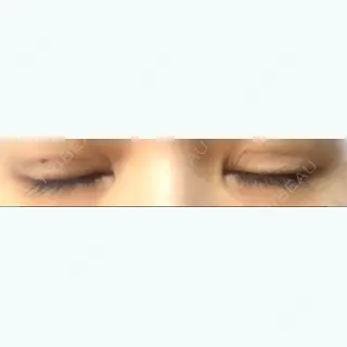 1日目の経過画像（2枚目）