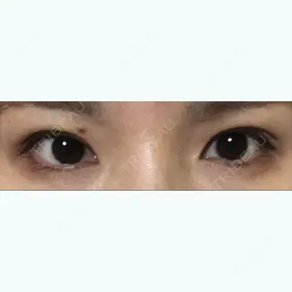 11日目の経過画像（1枚目）