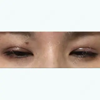 11日目の経過画像（2枚目）