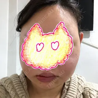 3日目の経過画像（1枚目）
