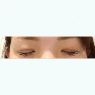2日目の経過画像（2枚目）