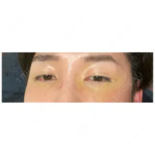 5日目の経過画像（1枚目）