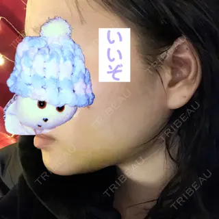 6日目の経過画像（3枚目）