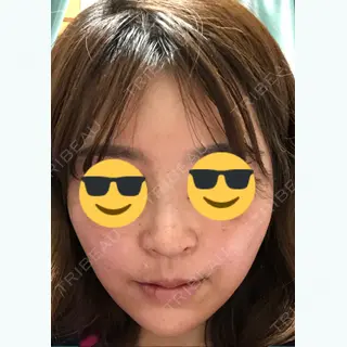 15日目の経過画像（3枚目）