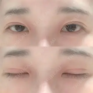 124日目の経過画像（1枚目）