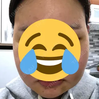 4日目の経過画像（1枚目）