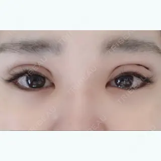 1日目の経過画像（1枚目）