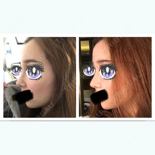 44日目の経過画像（1枚目）