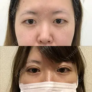 0日目の経過画像（1枚目）