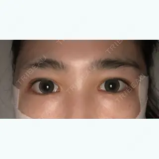 64日目の経過画像（1枚目）