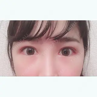 76日目の経過画像（2枚目）