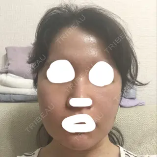 12日目の経過画像（1枚目）