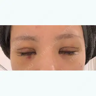 6日目の経過画像（2枚目）