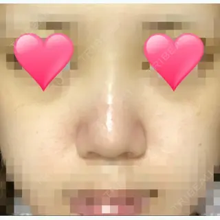 3日目の経過画像（1枚目）